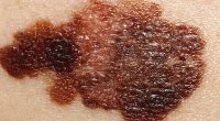 Melanoma