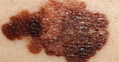 Melanoma