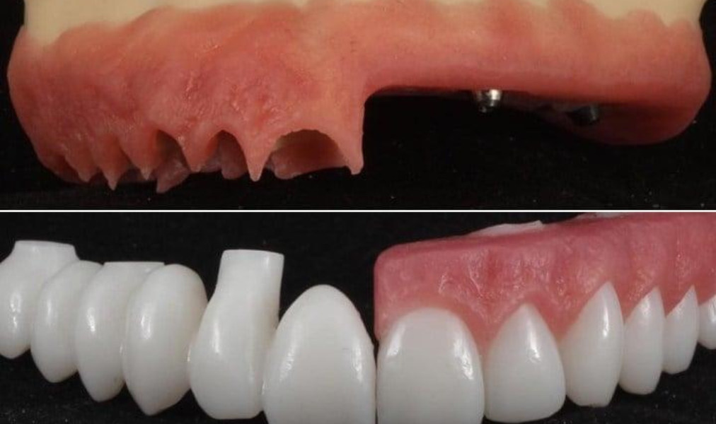 dentista utilizando tecnologia digital para planejamento de implante dentário em consultório moderno